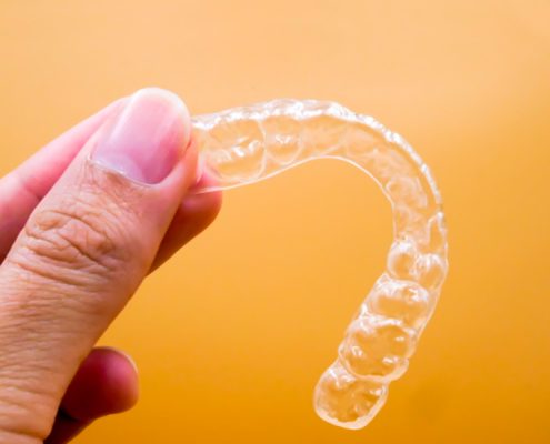 como utilizar la ortodoncia invisible