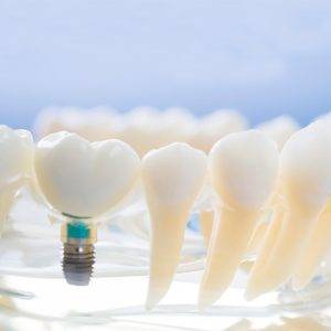 ¿Puedo usar la ortodoncia con implantes?