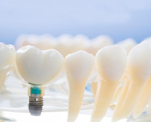 ¿Puedo usar la ortodoncia con implantes?