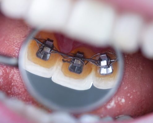 brackets linguales o internos