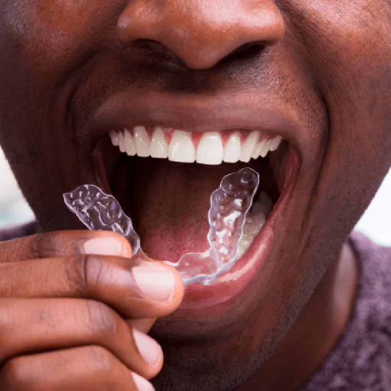 tipos de ortodoncia invisalign