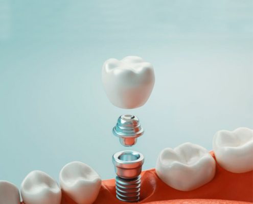 implante dental precio