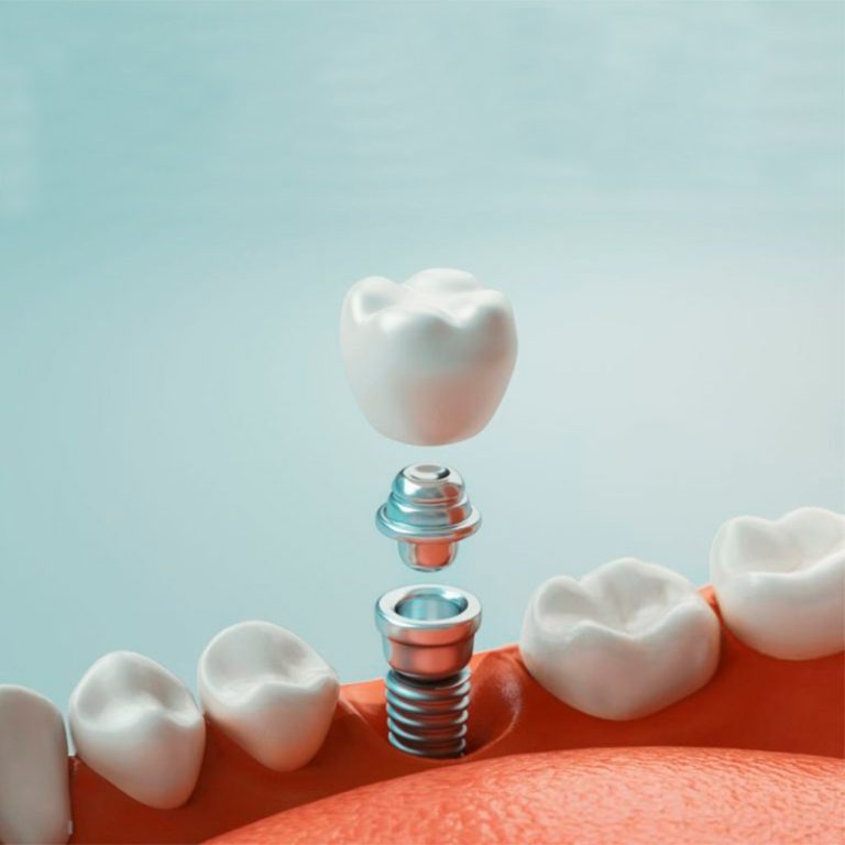 ¿Cuál es el precio de un implante dental?【2022】 sMySecret®