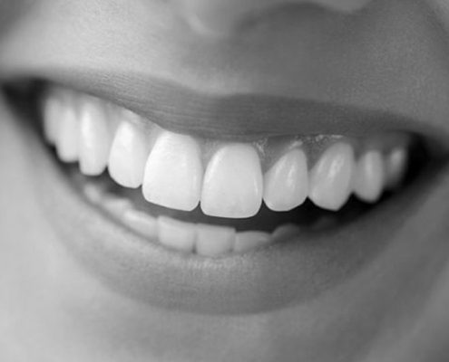 dientes blancos hollywood