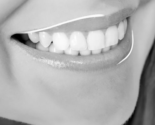 carillas dentales