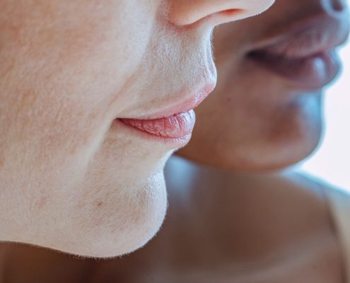 aparición de boqueras labiales