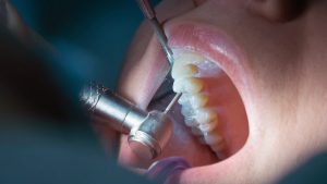 Así se ve una endodoncia