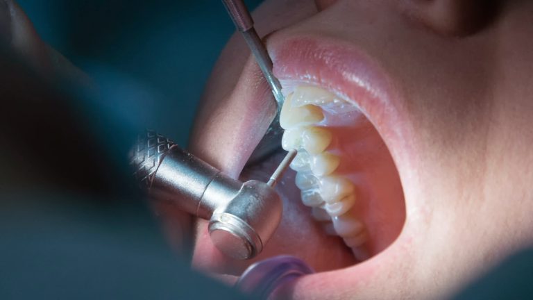 Así se ve una endodoncia