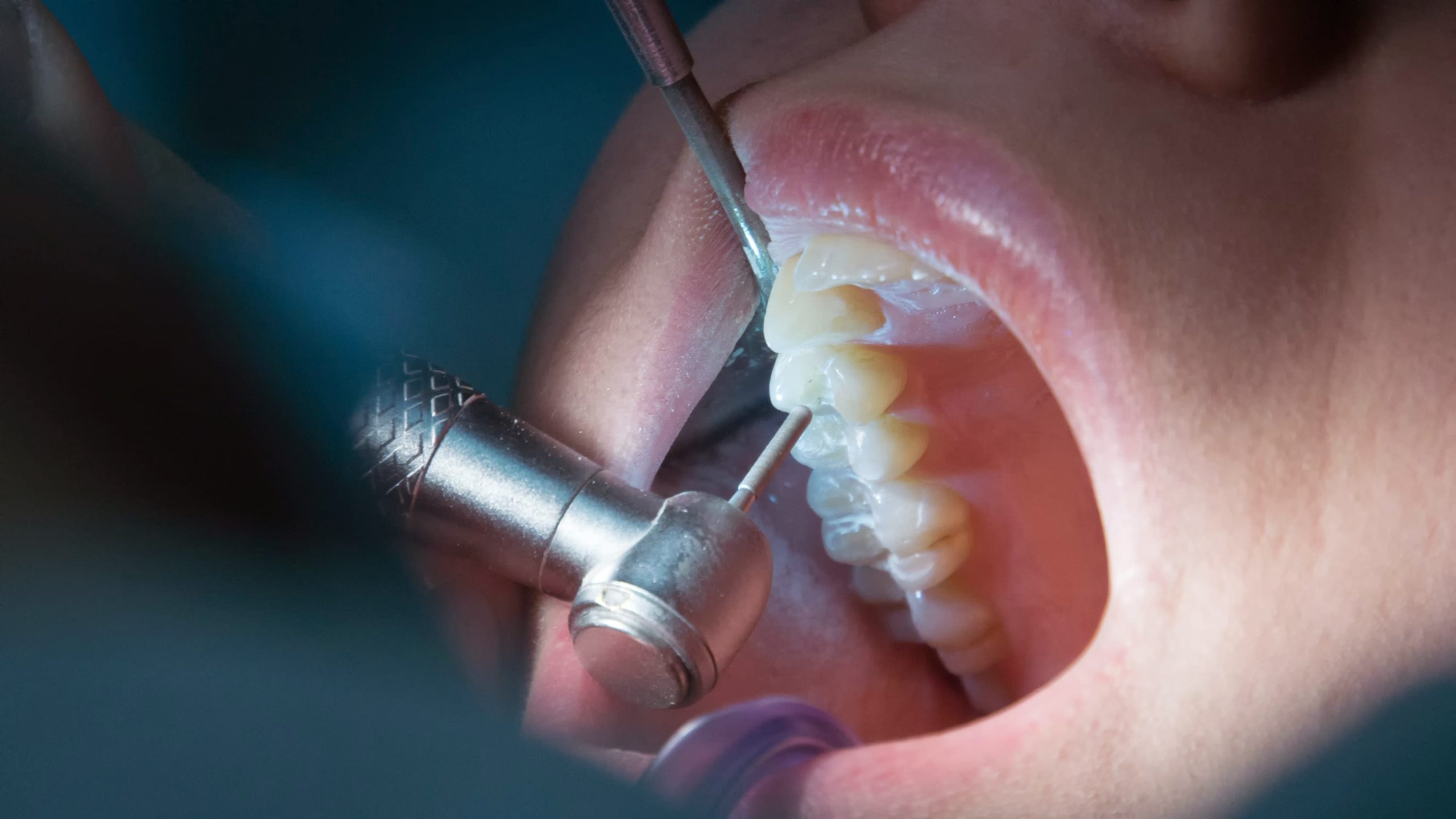 Así se ve una endodoncia
