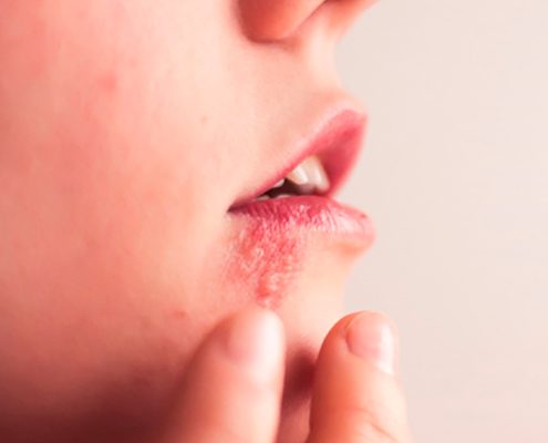 Gingivoestomatitis Herpética