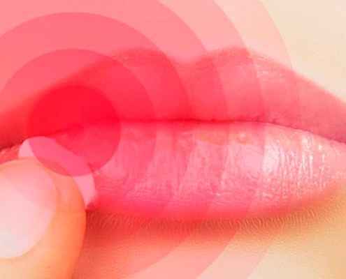 herpes labial