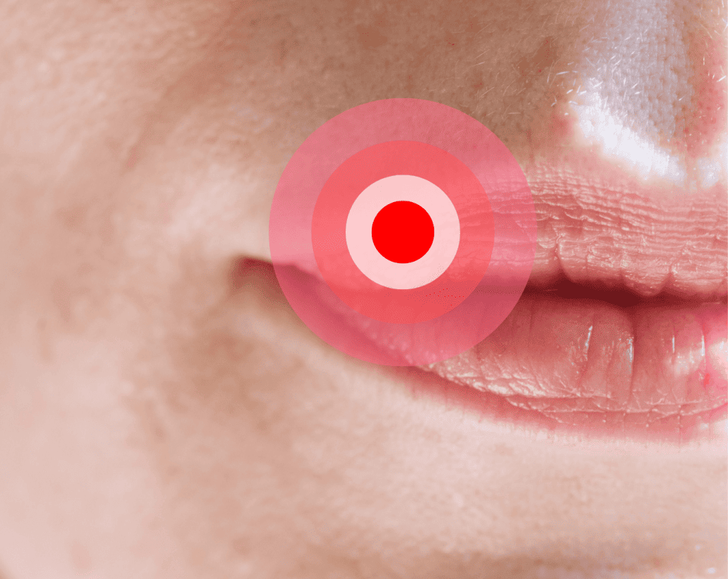 como curar un herpes labial