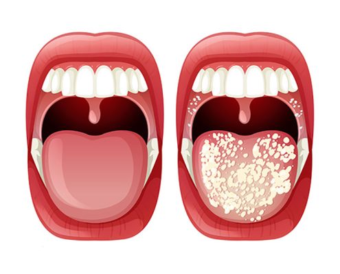 candidasis oral