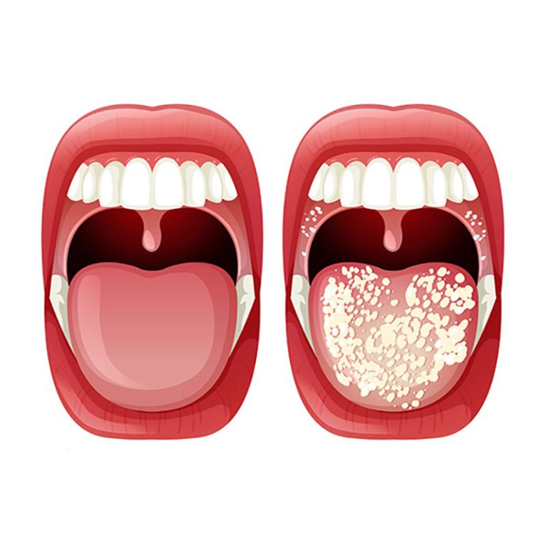 candidasis oral