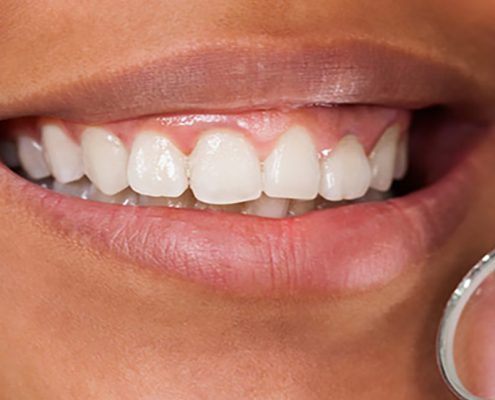 sonrisa gingival