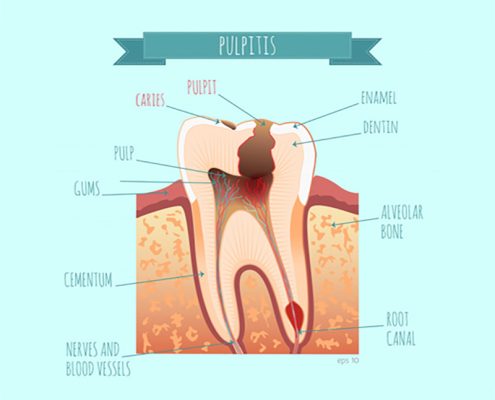 pulpitis
