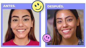 Antes y Despues del esmalte dental permanente