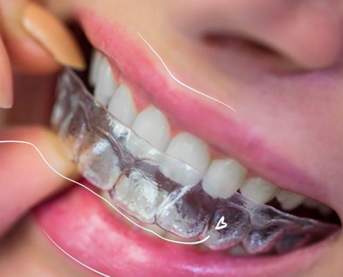 invisalign precio