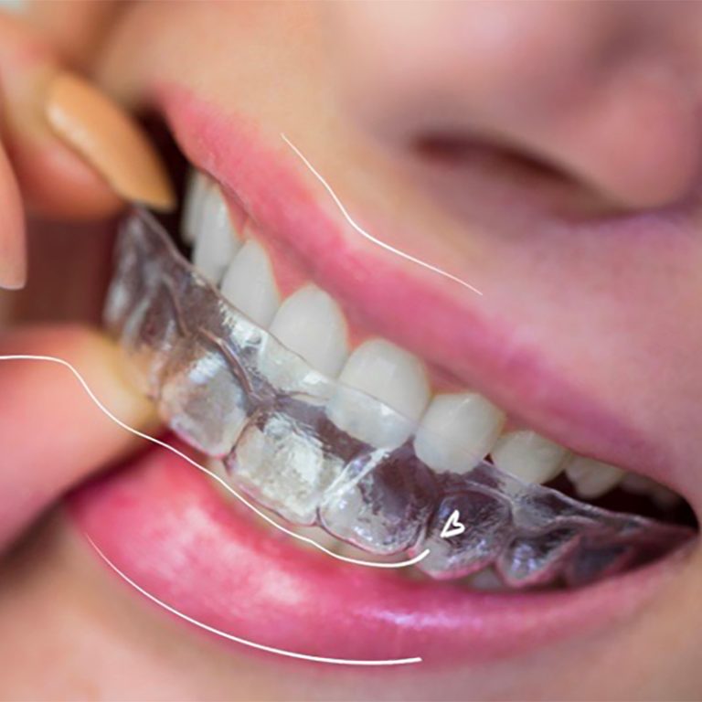 invisalign precio
