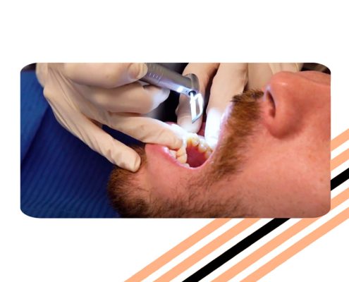 stripping dental