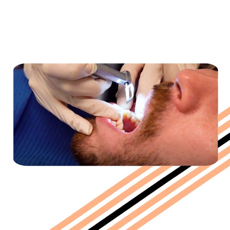 stripping dental