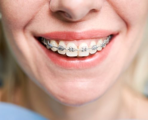 distintos tipos de brackets