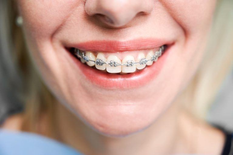 distintos tipos de brackets