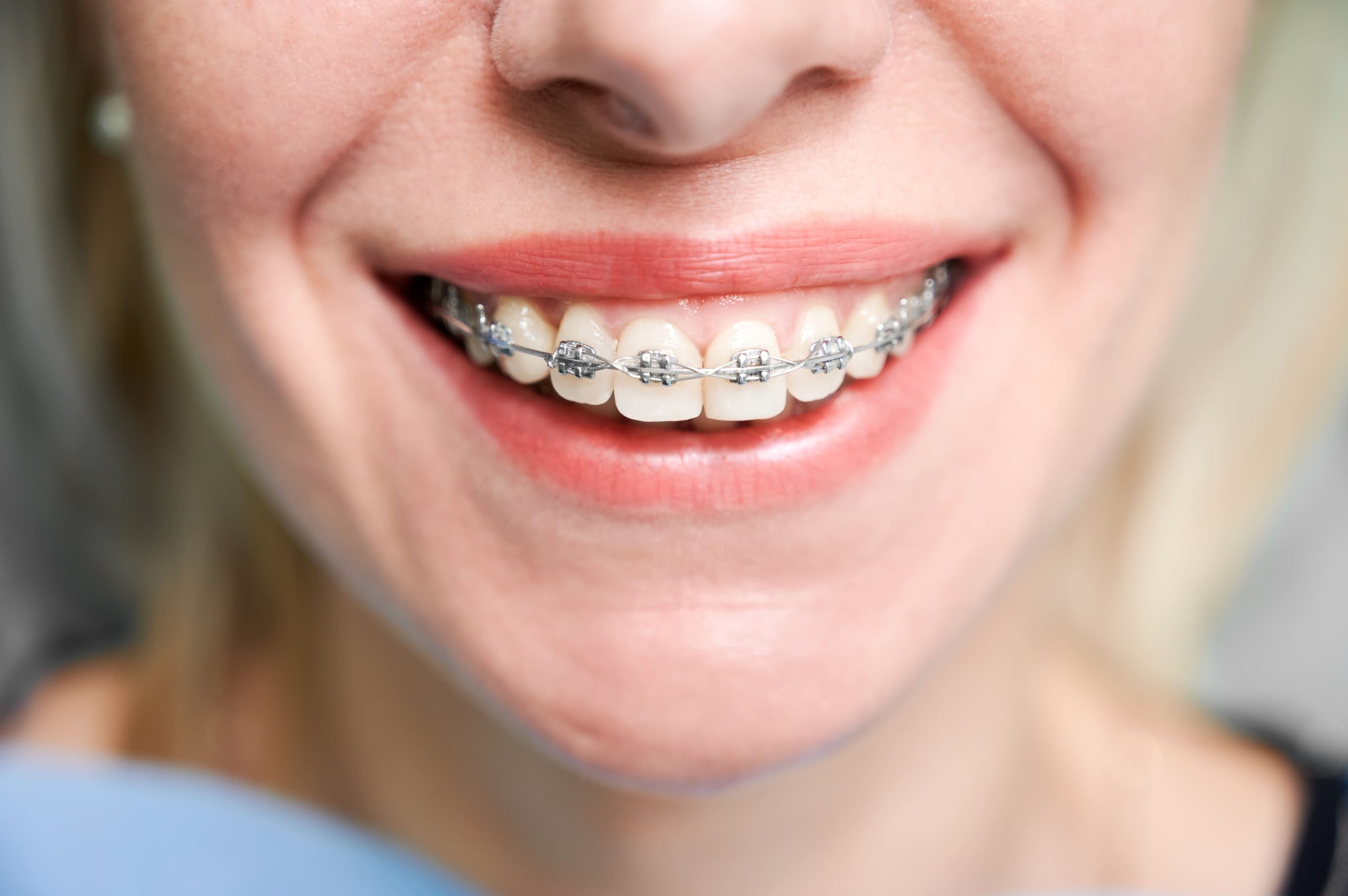distintos tipos de brackets