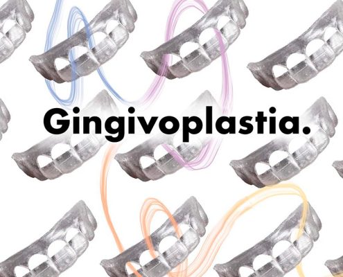 Consigue una sonrisa perfecta con la gingivoplastia