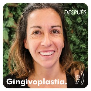 después de gingivoplastia