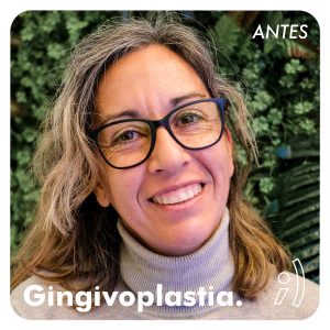 mujer con antes de gingivoplastia