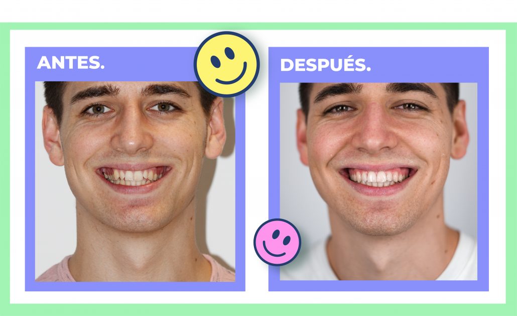 ortodoncia invisible antes y despues