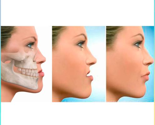 prognatismo mandibular