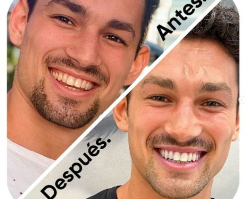 Blanqueamiento dental para solucionar los dientes amarillos