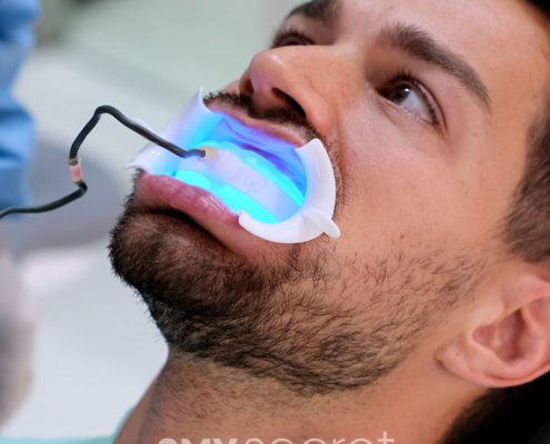 Causas y soluciones para los dientes amarillos