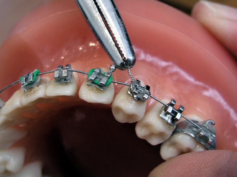 Vbdentalcare - ⭕️ Tipos de ligado ⭕️ En ortodoncia existen diferentes tipos  de ligado para hacer la fijación del alambre➰〰️ en el bracket. ⭕️ ligado  convencional: es esa modulo elástico en algunos