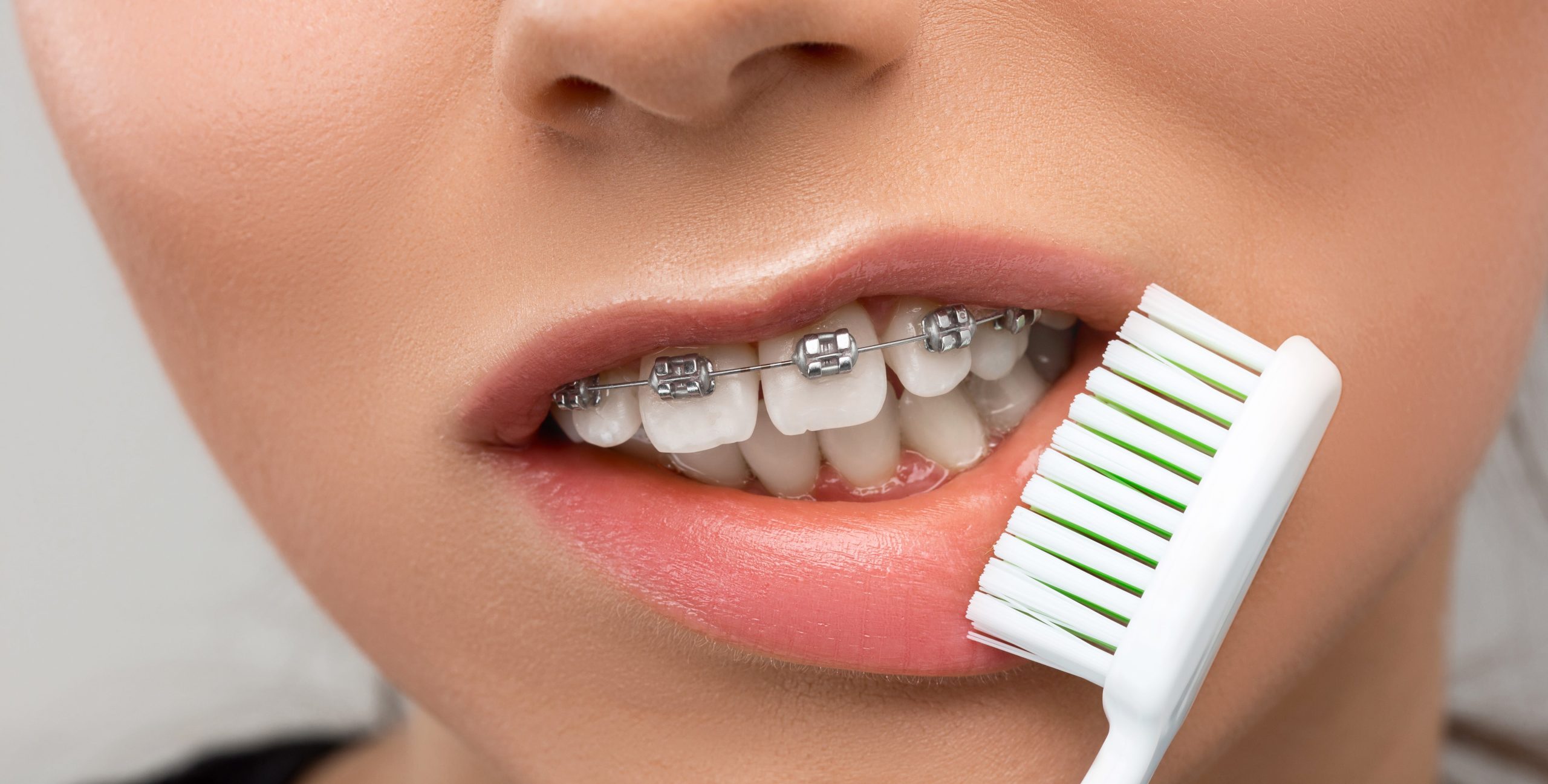 Así son los brackets metálicos