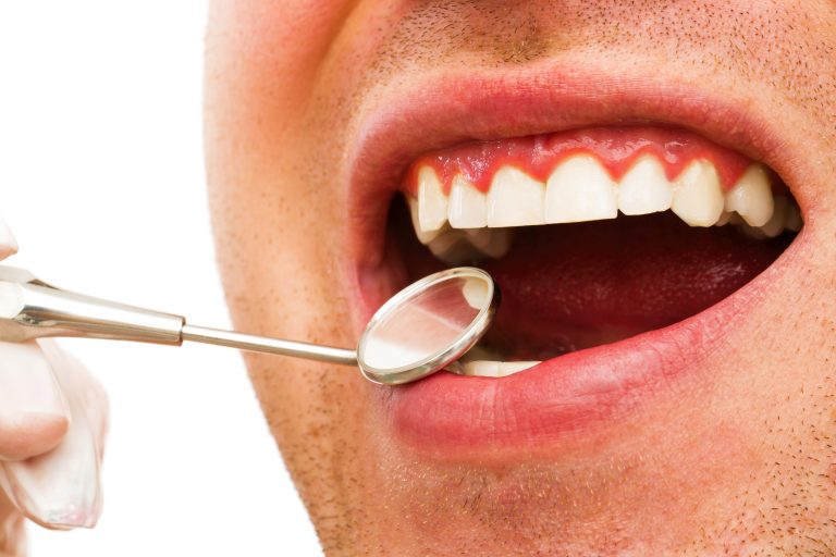 Estos son los síntomas de gingivitis más comunes