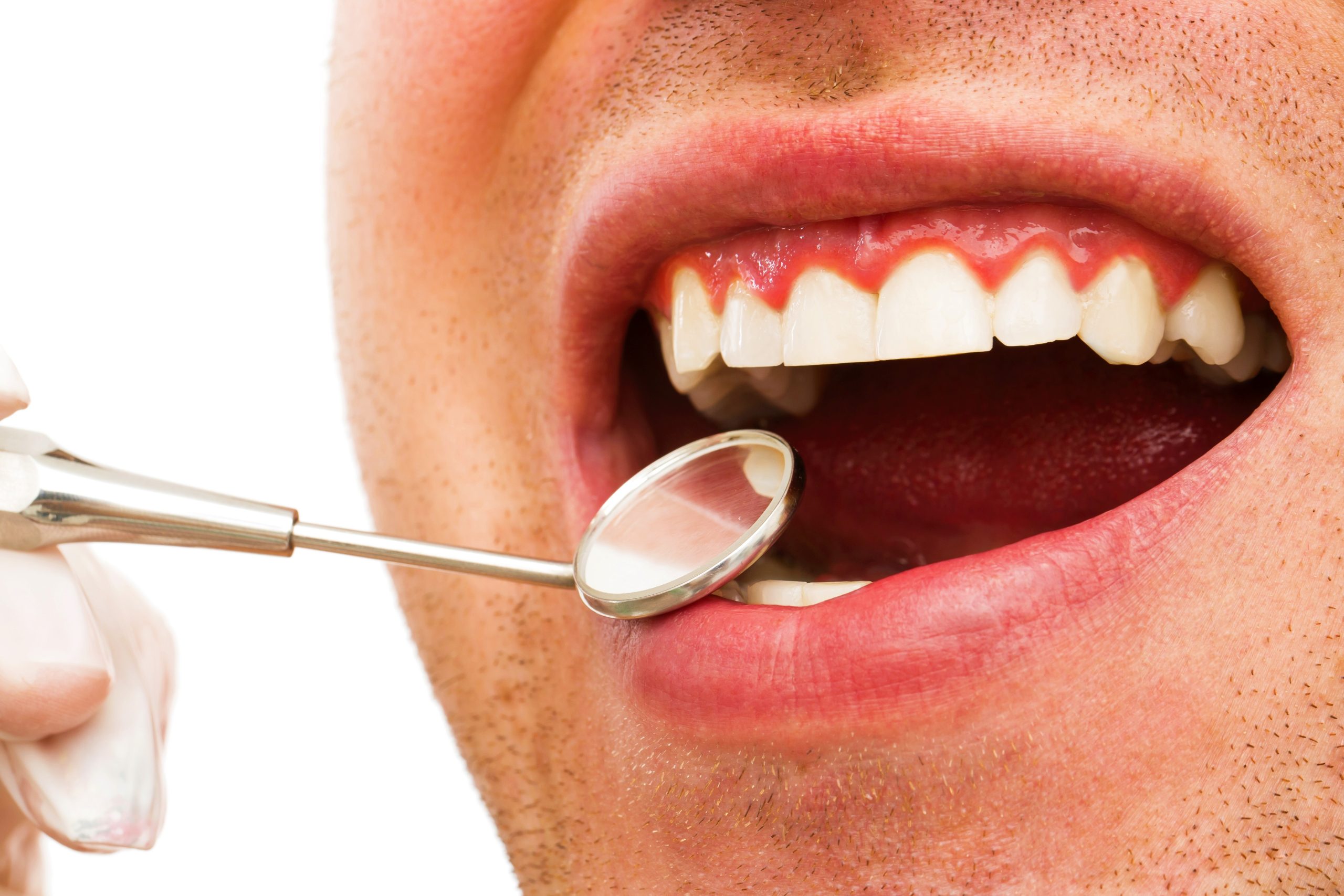 Estos son los síntomas de gingivitis más comunes