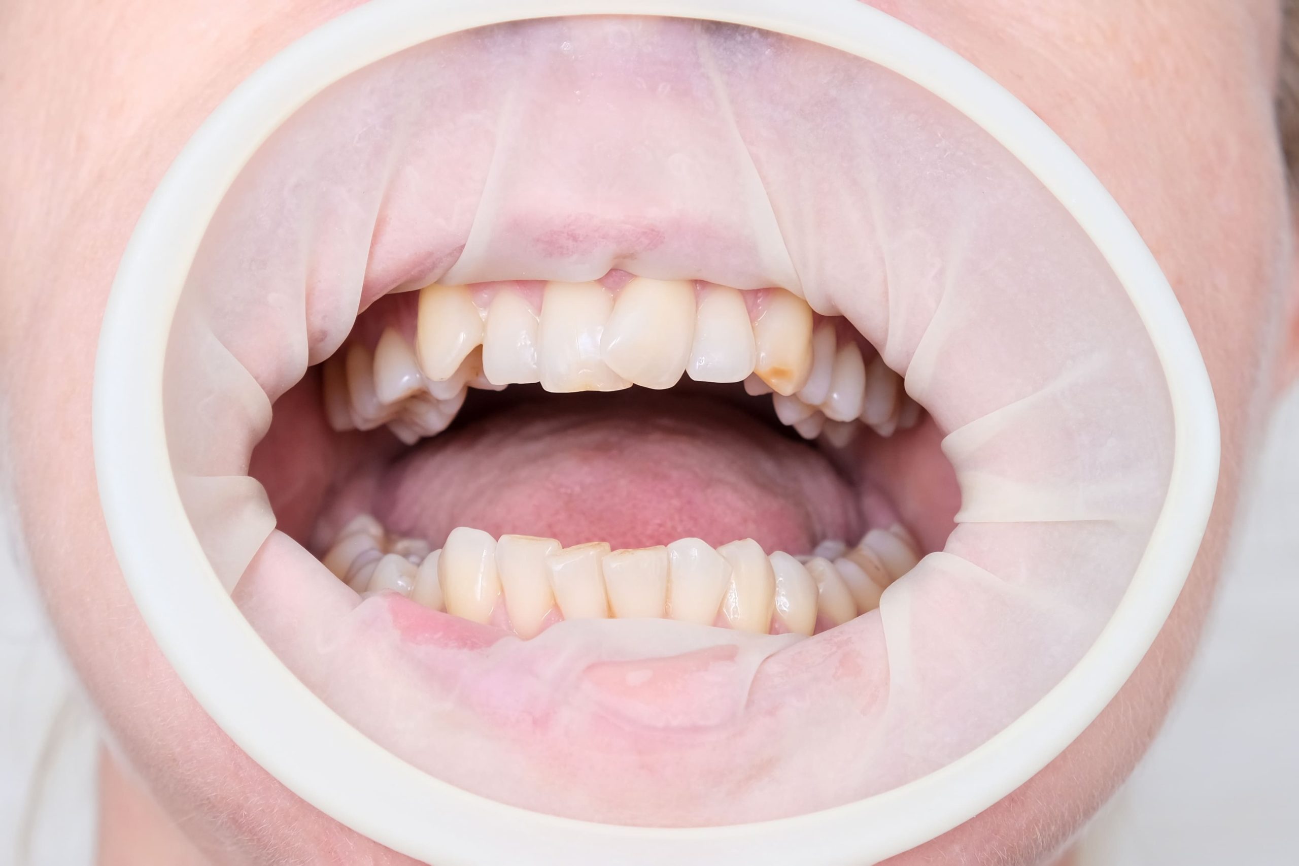 Las maloclusiones dentales