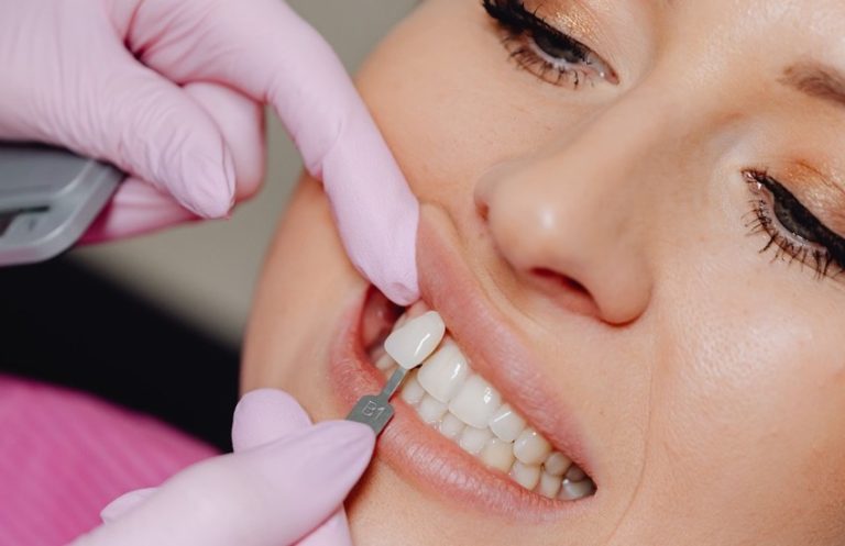Dientes limados para carillas