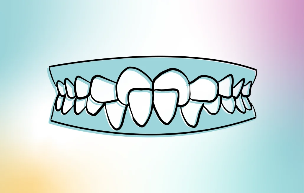 tener mordida cruzada