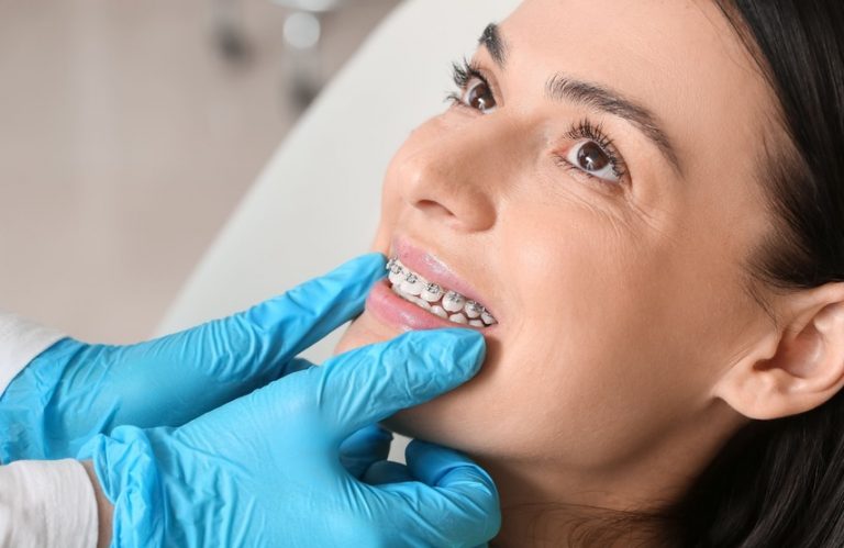 Brackets para corregir el apiñamiento dental