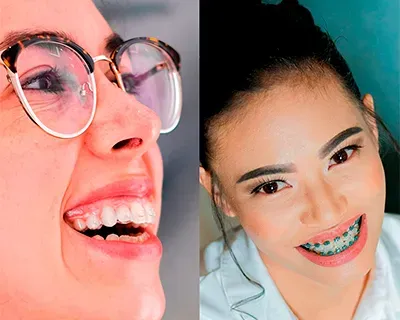 Alineadores invisibles o brackets: ¿Cuál es la mejor opción?