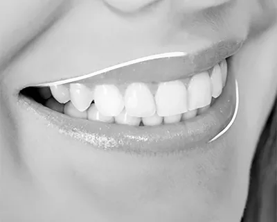 Carillas dentales: Precio y Tipos