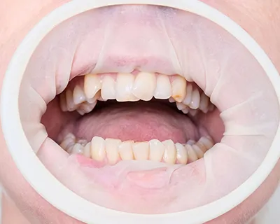 Maloclusión dental: ¿Qué es? ¿Cómo se corrige?