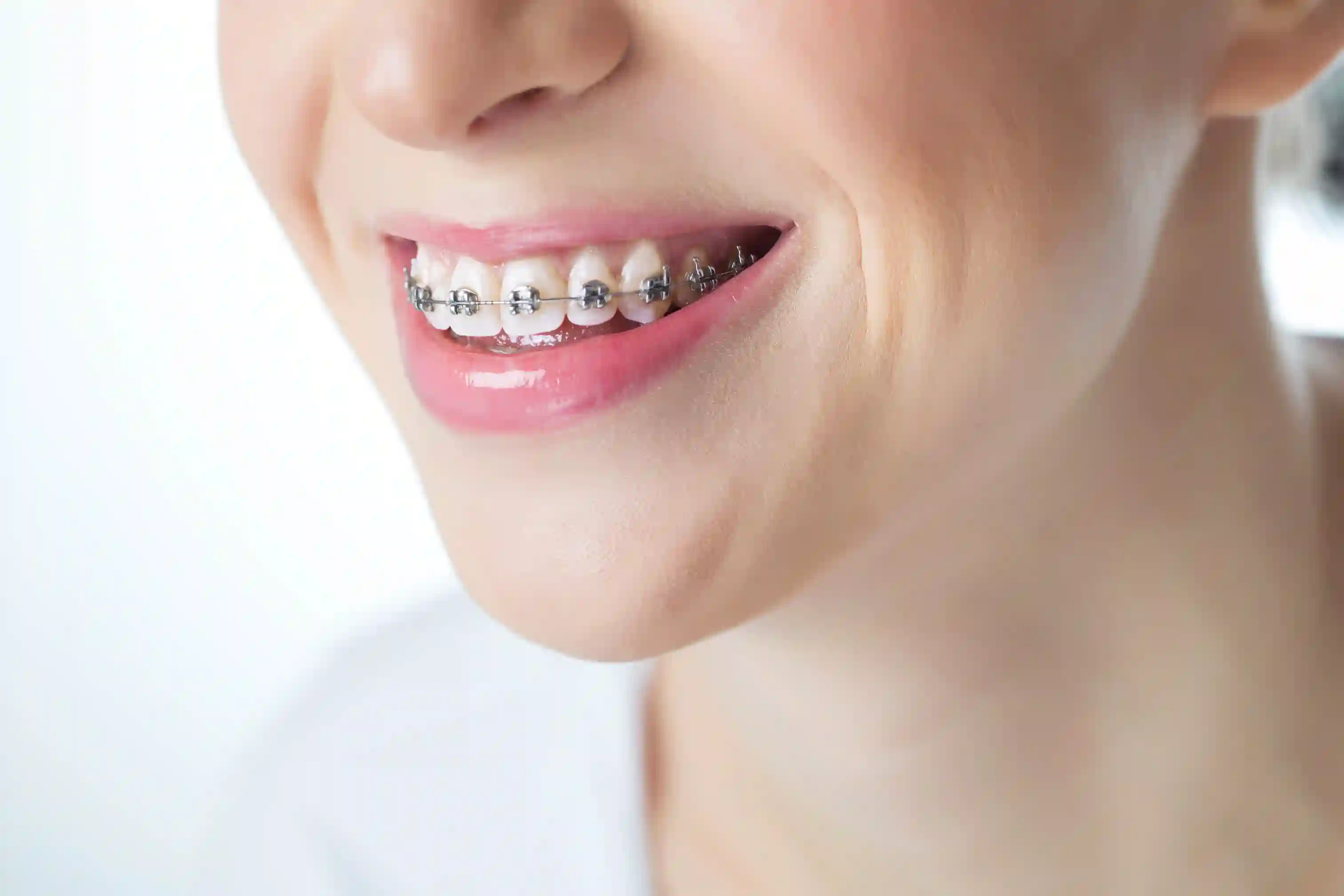 Carillas dentales de Smysecret.