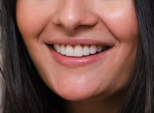 Sonrisa de una mujer después de haberse colocado carillas dentales de Smysecret.