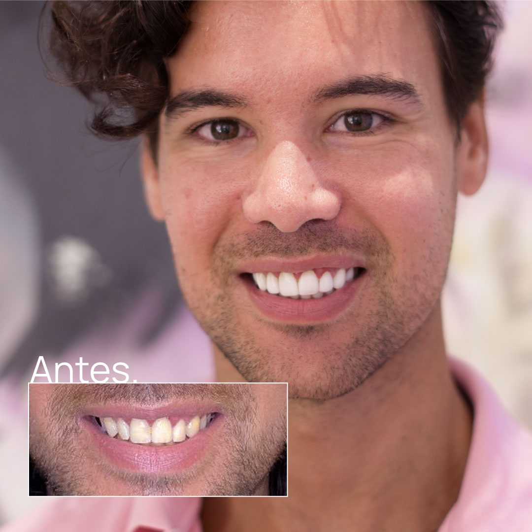 Carillas dentales