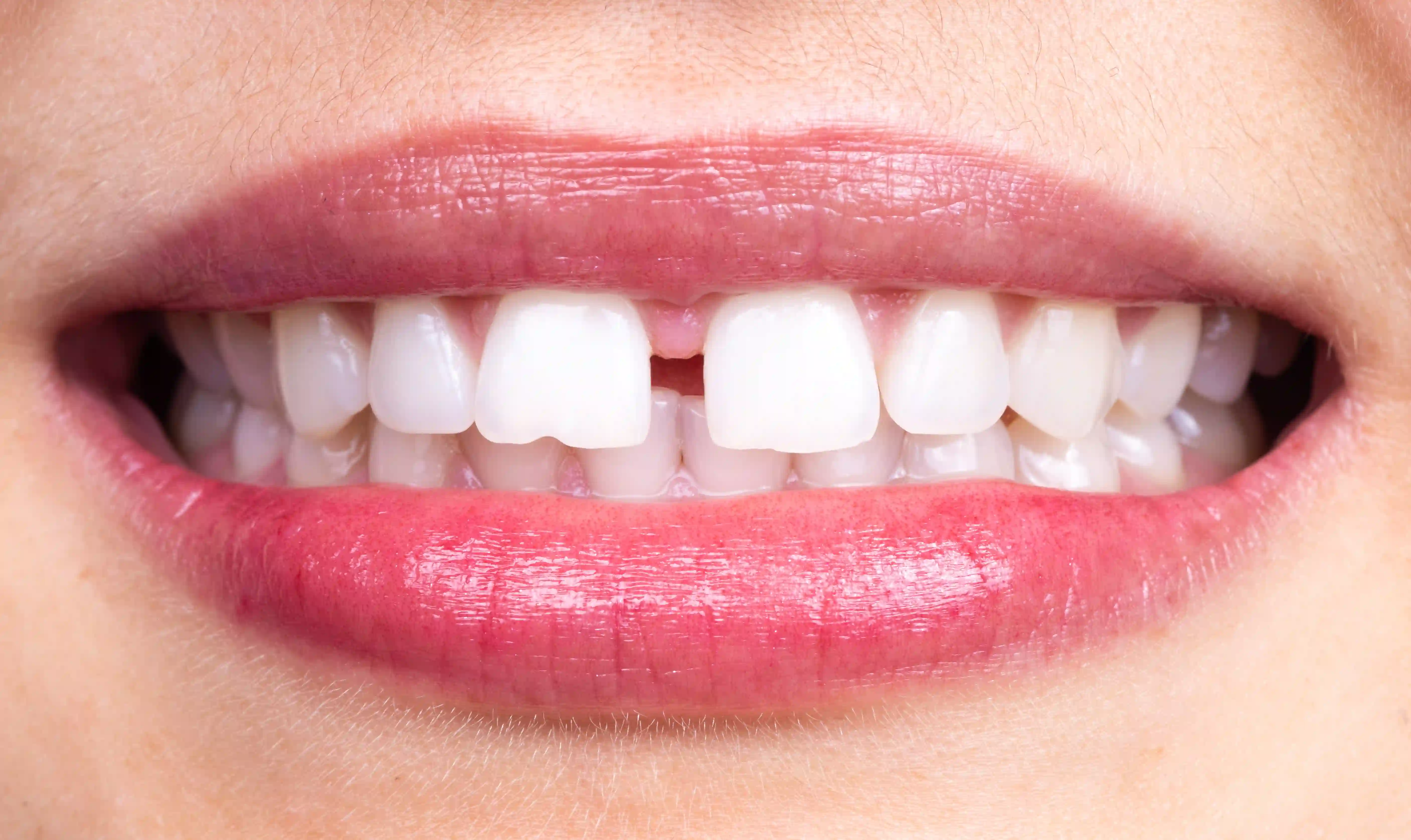 Carillas dentales de Smysecret.